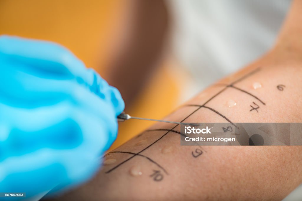 Mittels mehrerer Flüssigkeiten wird ein Allergietest auf einem Arm durchgeführt