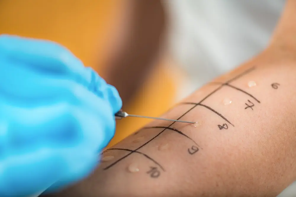 Mittels mehrerer Flüssigkeiten wird ein Allergietest auf einem Arm durchgeführt