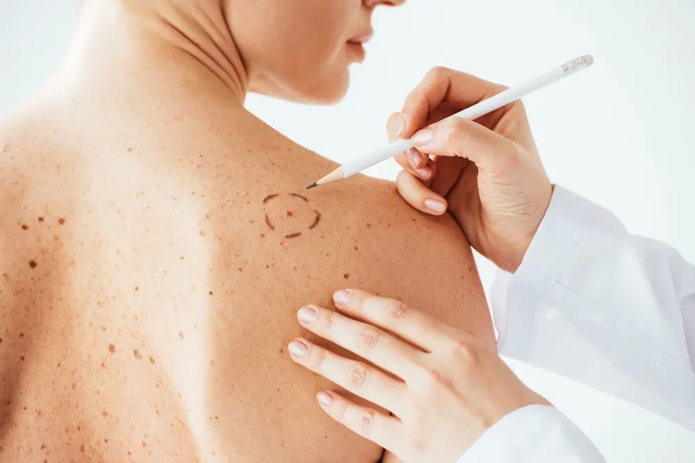 Eine Patientin mit vielen Leberflecken auf dem Rücken wird für die Hautkrebsbehandlung vorbereitet