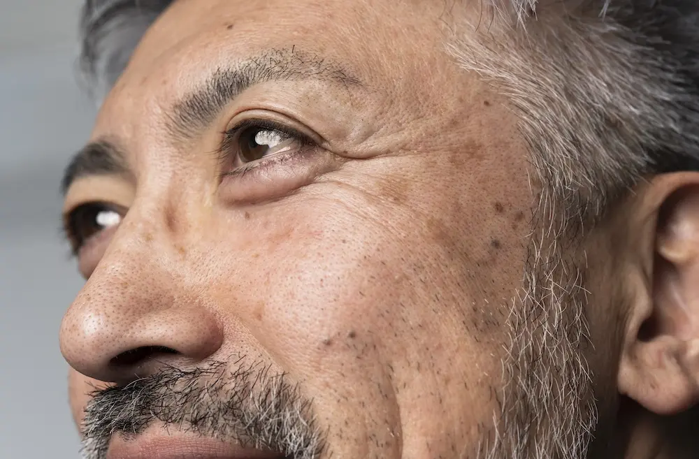 Ein Mann hat mehrere altersbedingte Flecken im Gesicht