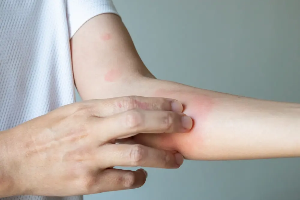 Eine Hand tastet nach Rötungen am Unterarm